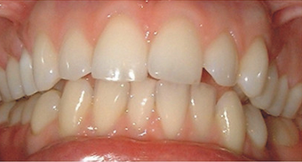 Natural shade veneers before 607256