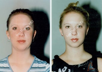 Liposuction before 242814