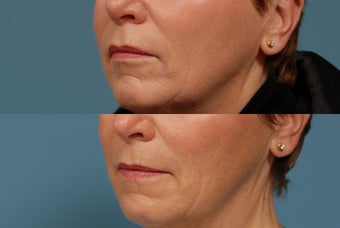 Sculptra area around mouth after 409236