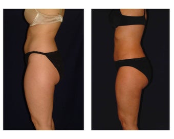Liposuction before 286639