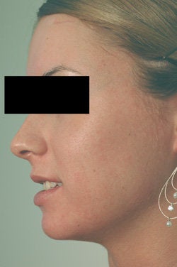 Pulsed Dye Laser Treatment for Acne/Rosacea after 104202