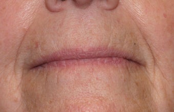 Restylane injection to nasolabial folds before 240182