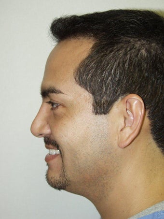 Revision Rhinoplasty after 299761