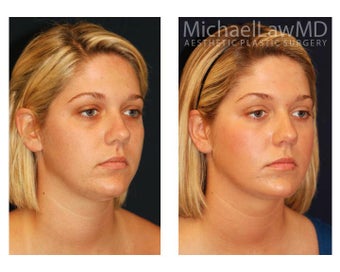 Chin Liposuction after 395411