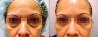 Lower Eyelid(Blepharoplasty) Surgery before 650667