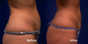 Tummy liposuction before 124244