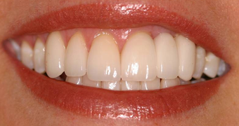 Invisalign, whitening, porcelain veneers and porcelain bridge after 119961