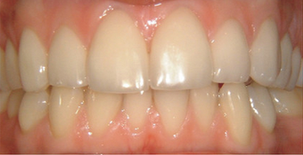 Natural shade veneers after 607256