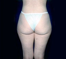 Smartlipo 401656