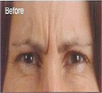 Botox before 395287