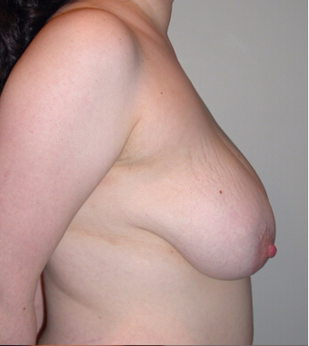 Vertical Breast Lift before 275504
