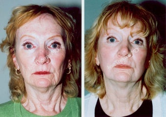 Non-Surgical Face Lift- Exoderm before 242968