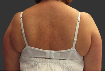 Exilis before 423762