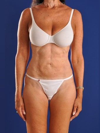 Vaser Hi Def Liposuction of abdomen, thighs, flanks and back with fat injections to buttocks after 422729