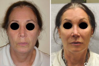 Facial Rejuvenation with Filler before 388074
