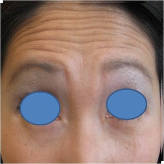 Botox before 83024