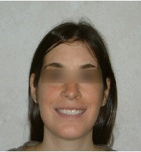 Invisalign Treatment 359168