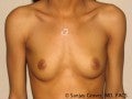 Breast Augmentation before 147533