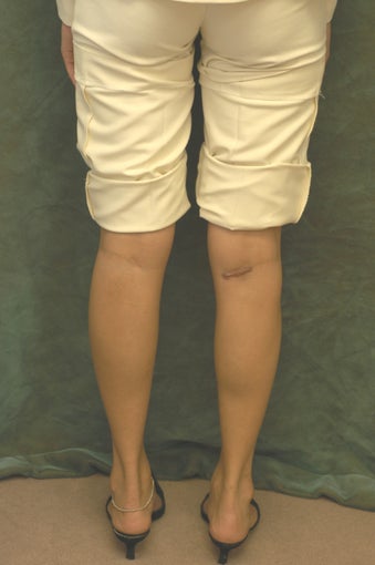 Women's Calf Augmentation after 519047