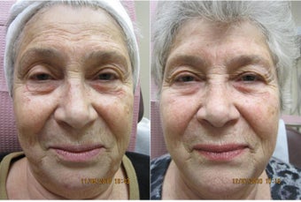 Photofacial IPL before 315017