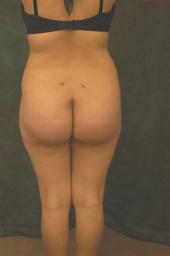 Women's Buttocks Augmentation 518152