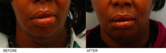 African-American Lip Reduction before 153118