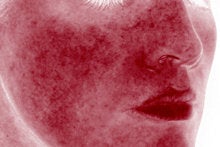 Laser Genesis for Overall Redness 326789