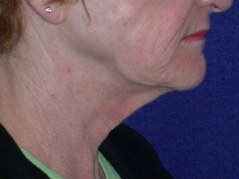 Necklift 208438