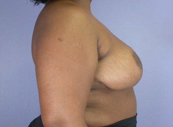 Breast Reduction after 285333