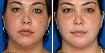 Chin Implant before 495866