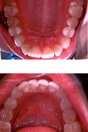 Invisalign before 109380