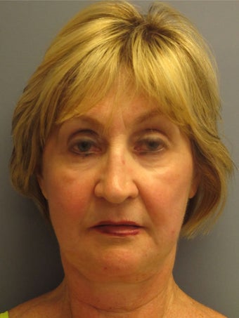 Neck Lift, Platysmaplasty before 634755