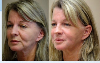 Liquid Facelift with Female before 350087