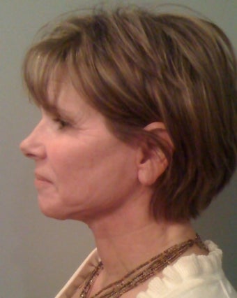 Laser Mini Facelift after 179309