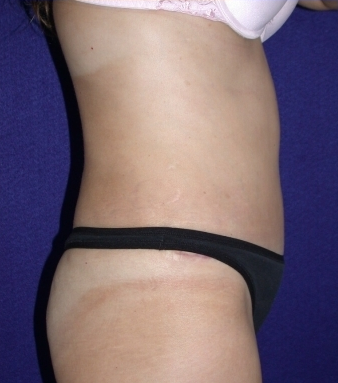Tummy Tuck (abdominoplasty) 208478