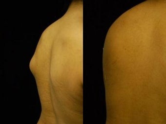 Lipoma Removal with Smartlipo Triplex after 600029