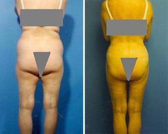 Liposuction before 636108