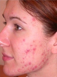 PDT for acne before 376114