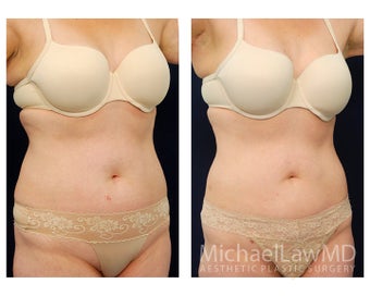 Liposuction after 397201
