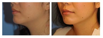 Chin Liposuction before 640671