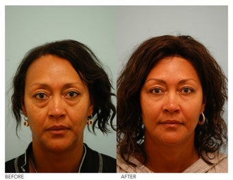 Fat Transfer/Fat Grafting/Facial Rejuvenation before 136357