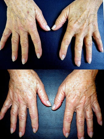 Filler of Doral Hands before 515609