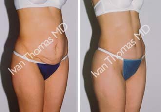 Tummy Tuck before 242522