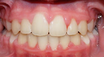 Teen Orthodontic Treatment (case #1JM) after 224715