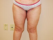 Thigh Lift after 601380