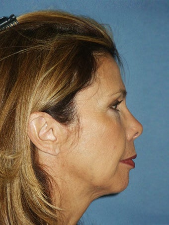 Chin augmentation with facial rejuvenation before 250151