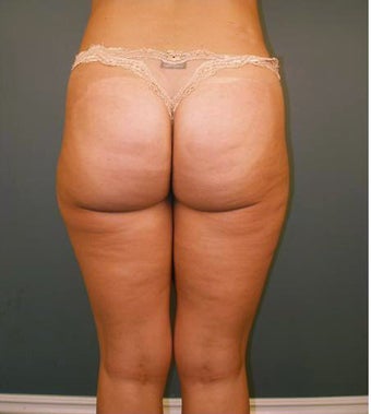 Tumescent Liposuction after 552078