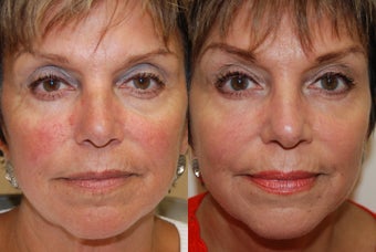 Non-Surgical Facial Rejuvenation with Silikon-1000 before 187667