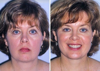 Liposuction of neck and chin augmentation before 332849