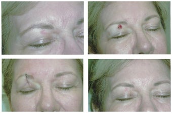 MOHS Skin Cancer Surgery before 369219